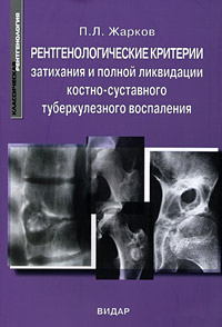 Рентгенологические критерии затихания и полной ликвидации костно-суставного туберкулезного воспаления