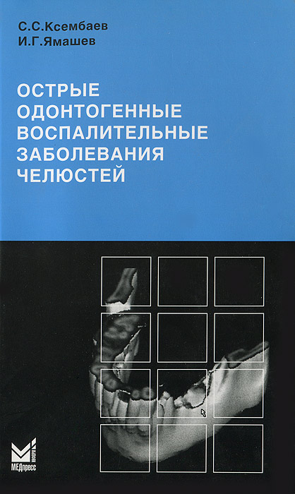 Острые одонтогенные воспалительные заболевания челюстей