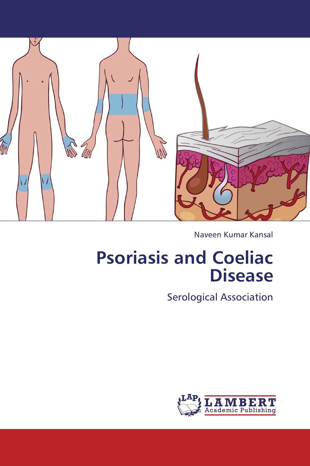 Psoriasis and Coeliac Disease