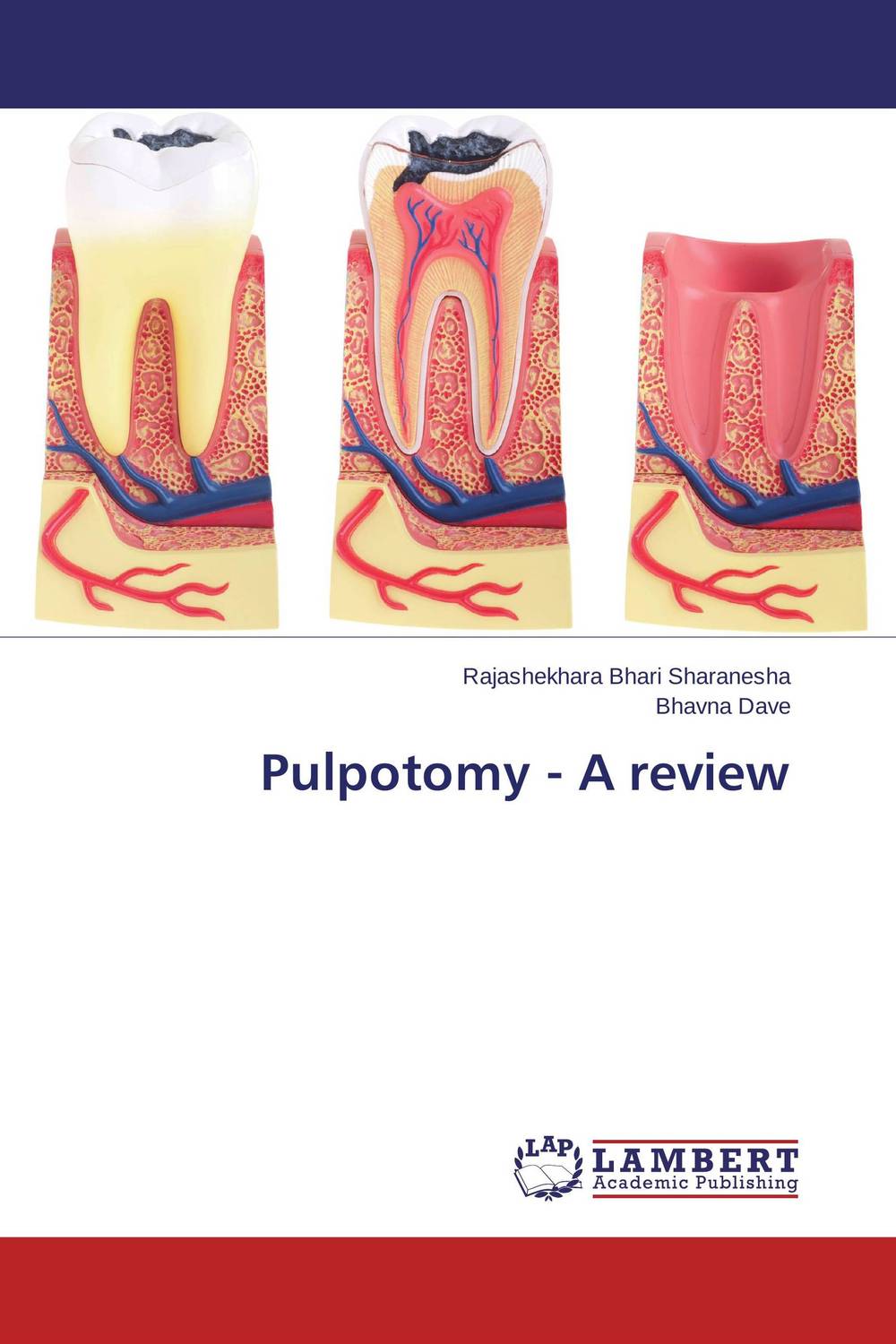 Pulpotomy - A review