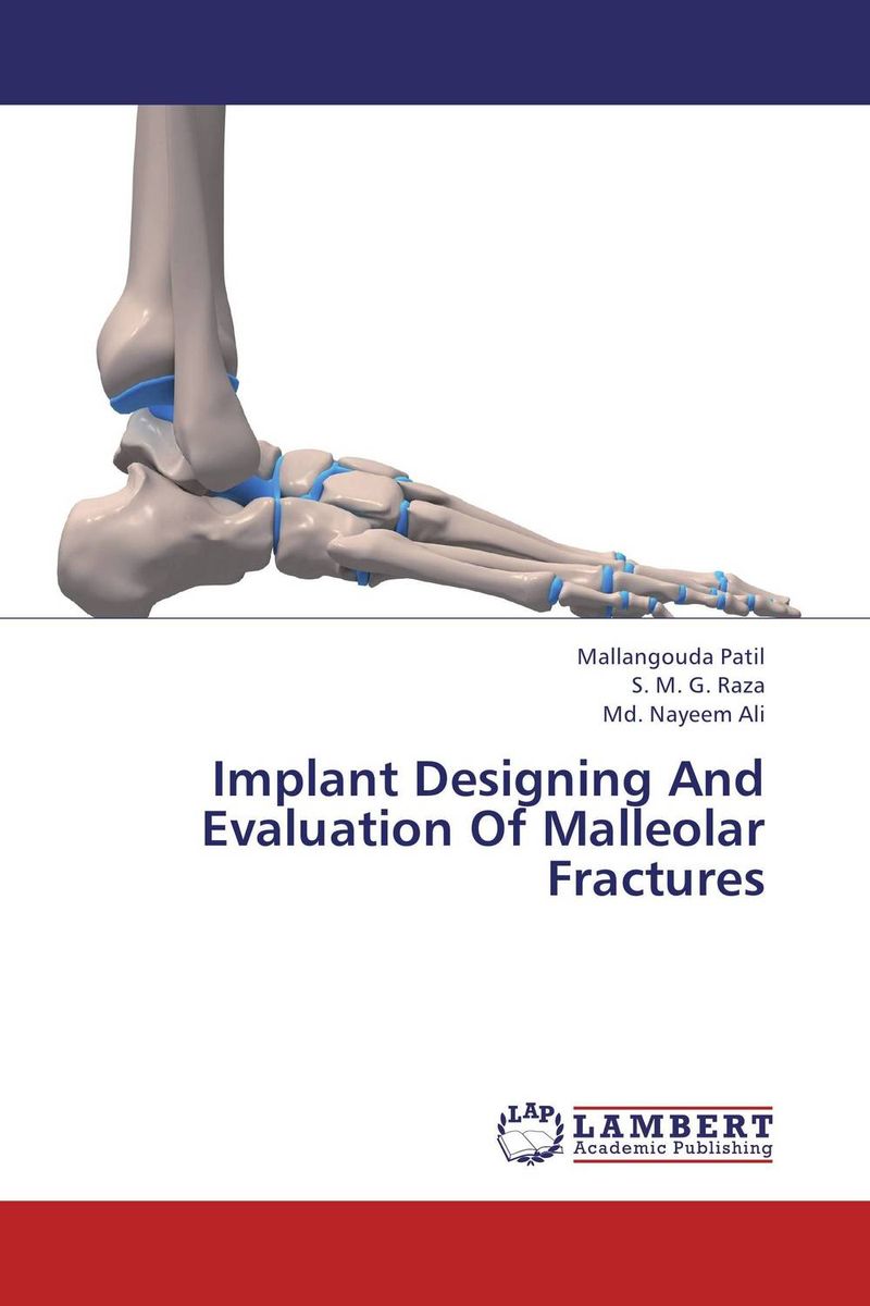 Implant Designing And Evaluation Of Malleolar Fractures